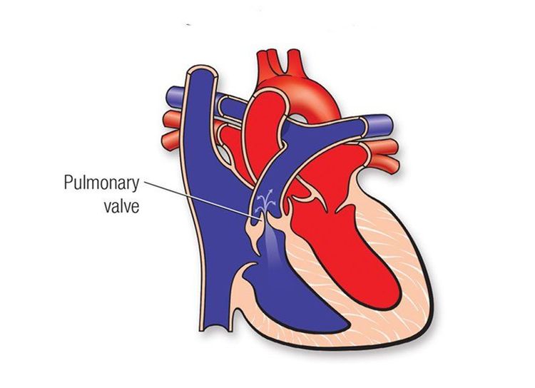 
Hình ảnh tim bẩm sinh bị hẹp động mạch phổi
