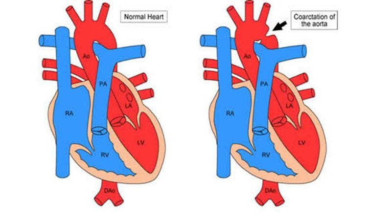 
Hình ảnh tim bẩm sinh hẹp động mạch chủ
