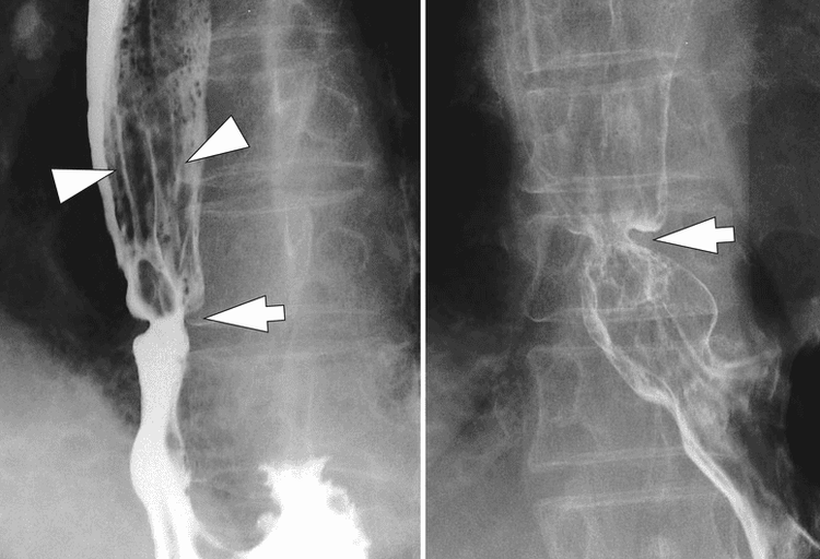 
Hình 12: Hẹp thực quản do viêm thực quản trào ngược (Nguồn: radiologykey.com)
