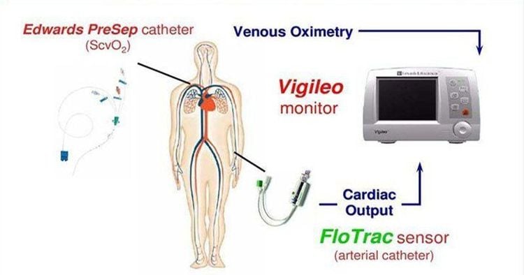 
Hình 3: hệ thống Flotrac Sensor
