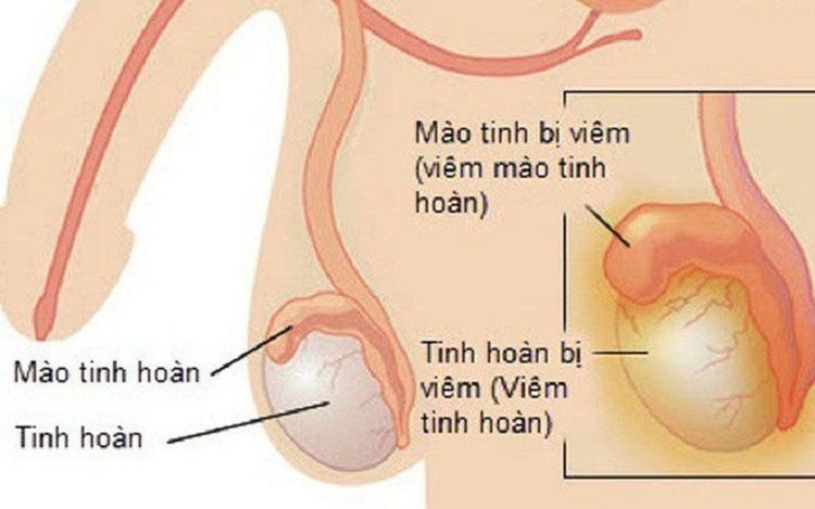 
Hình ảnh vị trí viêm mào tinh hoàn
