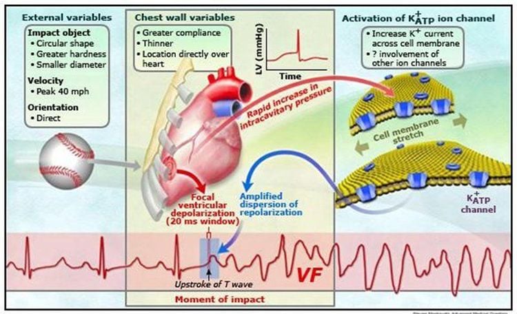 
Cơ chế gây ngừng tim trong chấn động tim
