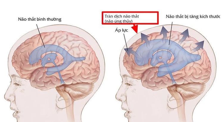 
Biến chứng thường gặp của viêm màng não do lao - tràn dịch não
