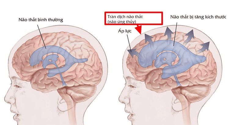 
Biến chứng thường gặp của viêm màng não do lao - tràn dịch não
