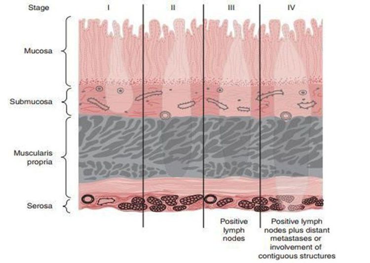 
Hình 1. Staging trong ung thư dạ dày. Phần xám là ung thư xuyên qua niêm mạc.
