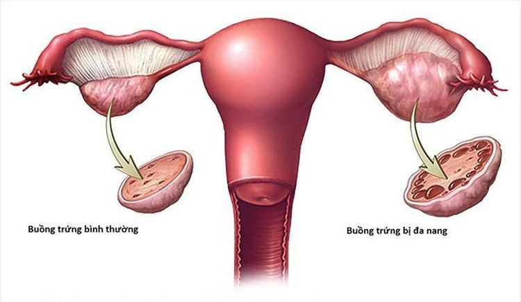 
Nếu bạn mắc hội chứng buồng trứng đa nang có thể là một yếu tố làm tăng khả năng bị bệnh tiền tiểu đường
