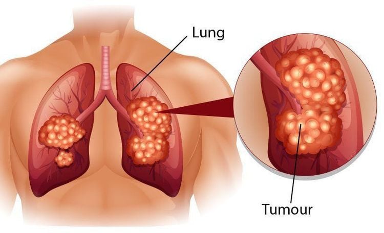 
Chụp MRI lồng ngực giúp tầm soát bệnh ung thư phổi
