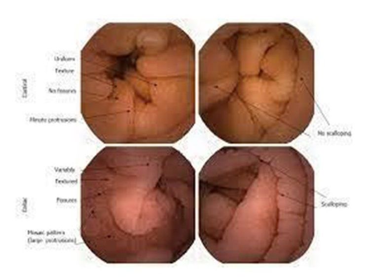 
Hình ảnh nội soi viên nang của bệnh nhân bị bệnh lý Celiac
