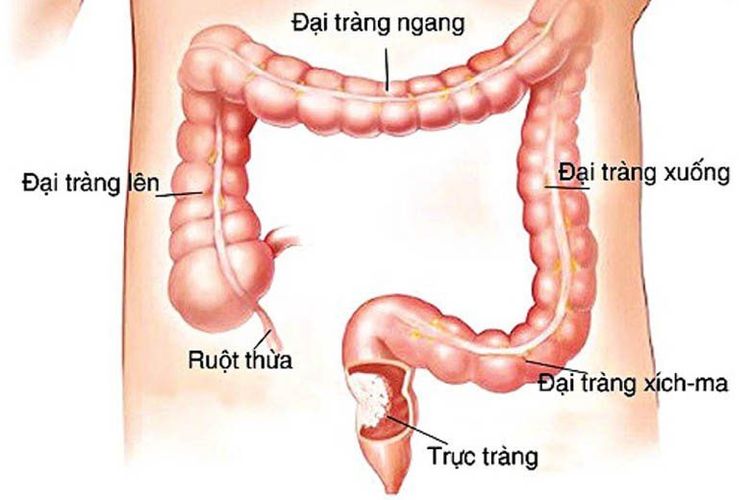 
Sa nội tạng vùng chậu có thể sa xuống vùng trực tràng
