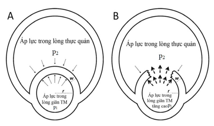 
Cơ chế vỡ giãn tĩnh mạch thực quản.
