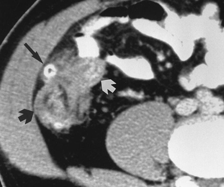 
Hình ảnh CT của viêm túi thừa manh tràng (Nguồn: Jang H.J., et al. (2000), 