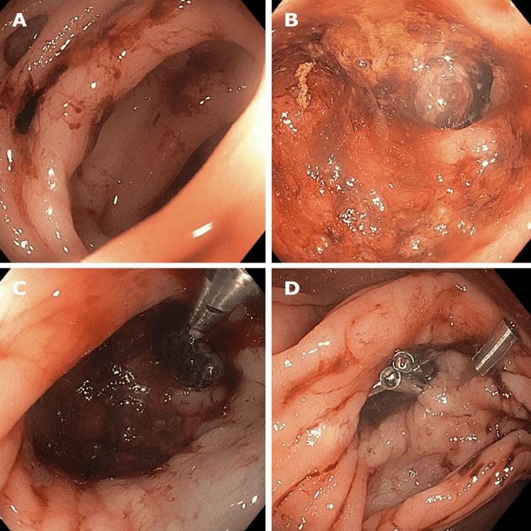 
Nội soi điều trị chảy máu túi thừa. A: Túi thừa có máu tươi gần đó; B: Sự Mạch máu được nhìn thấy được bên trong túi thừa; C: Kẹp clip mạch máu được nhìn thấy sau tiêm dưới niêm mạc 1: 10000 epinephrine; D: Kẹp clip bổ sung được thực hiện để đảm bảo cầm máu lâu hơn.
