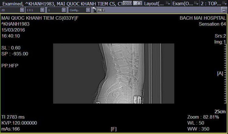 Điều trị đau thắt lưng – Đau thần kinh tọa bằng phương pháp tiêm thẩm phân