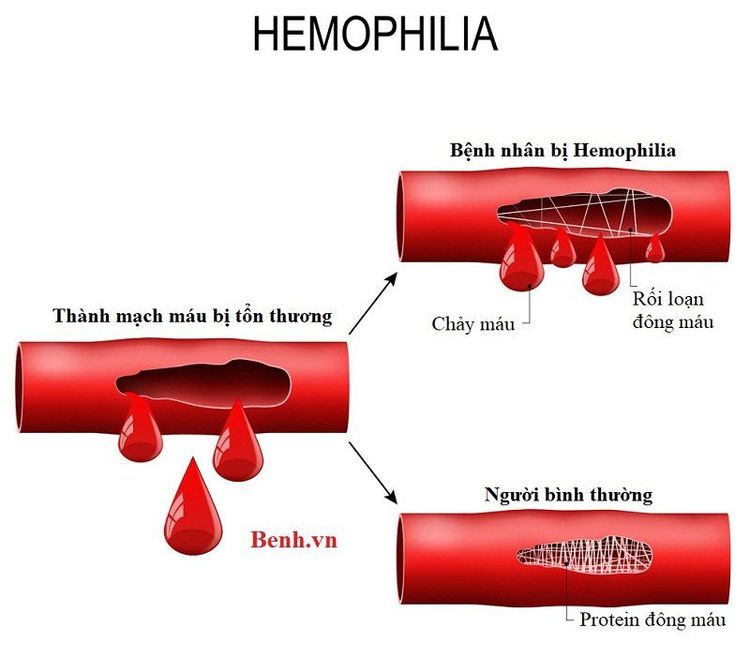 
Xét nghiệm máu giúp chẩn đoán rối loạn chảy máu trong bệnh máu khó đông
