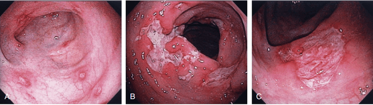 
Hình ảnh loét đại tràng đa ổ do bệnh Crohn
