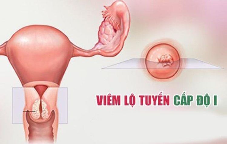 
Viêm lộ tuyến 1cm là cấp độ 1
