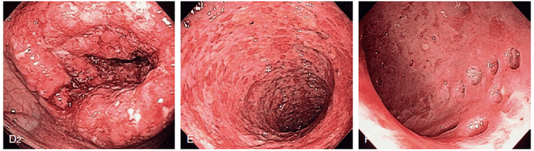 
Hình ảnh nội soi của bệnh Crohn
