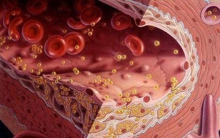 
Mỡ máu hay còn gọi là cholesterol, một loại chất béo trong máu được cơ thể sản xuất tự nhiên
