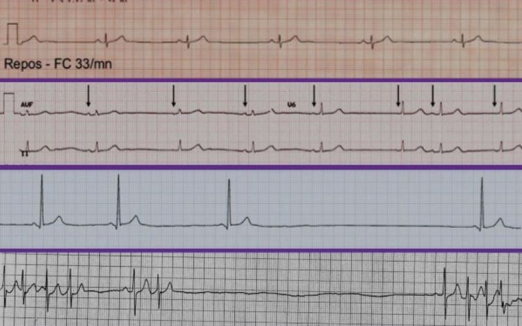 
Hình ảnh suy nút xoang trên kết quả ECG
