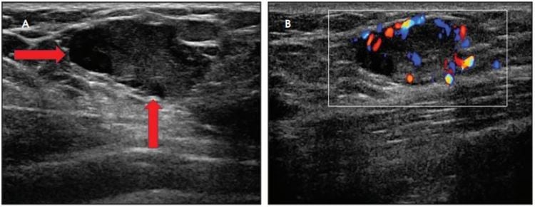 
Hình 2: Bệnh nhân nữ mang thai 28 tuần có khối ở vú phải. Siêu âm thấy khối hồi âm kém có thành phần nang bên trong, tăng tưới máu bên trong. Sinh thiết vú kết quả u tuyến sữa.

