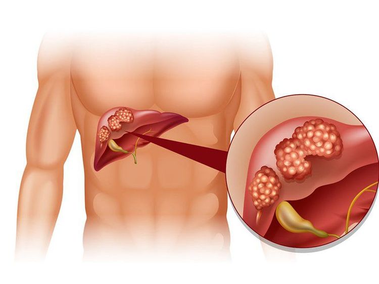 Gan thận đa nang điều trị như thế nào?