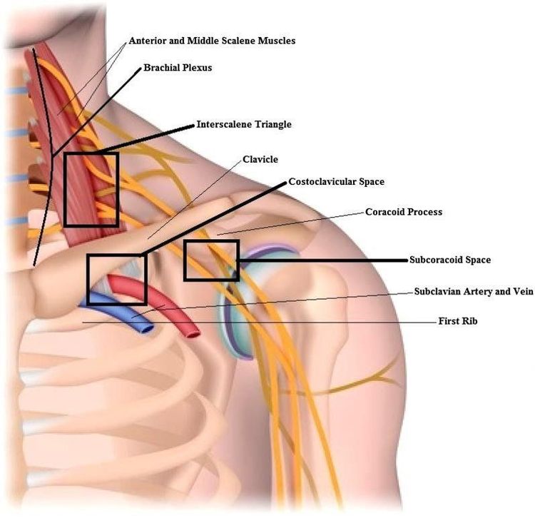 
Hình 1: Các khoang giải phẫu của hội chứng lối thoát ngực (Nguồn: PubMed)
