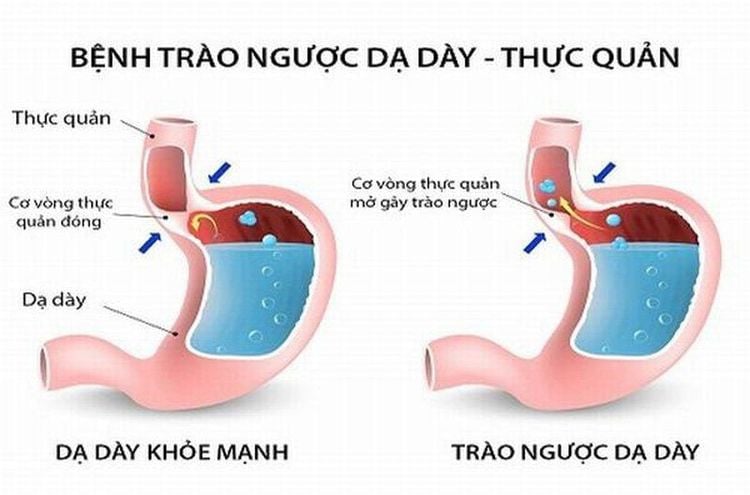 
Trào ngược axit không được điều trị kịp thời sẽ gây ra nhiều hậu quả nghiêm trọng
