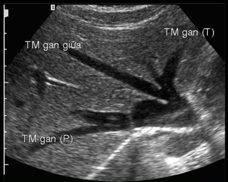 Hình ảnh siêu âm gan.
