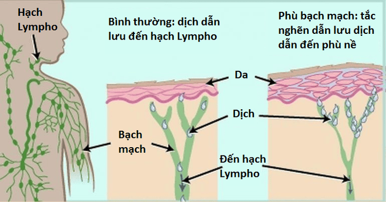 
Hình 2. Cơ chế của phù bạch mạch
