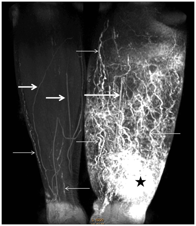 Imaging features of lymphedema