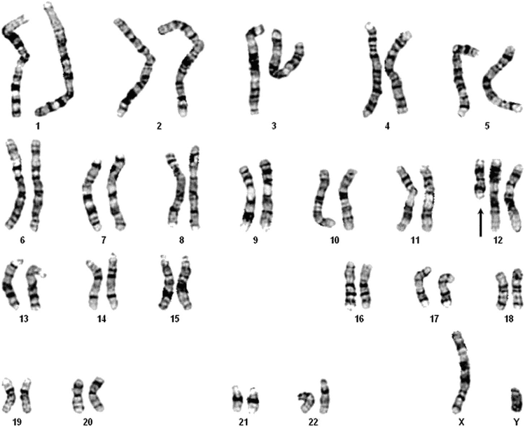 Isochromosome