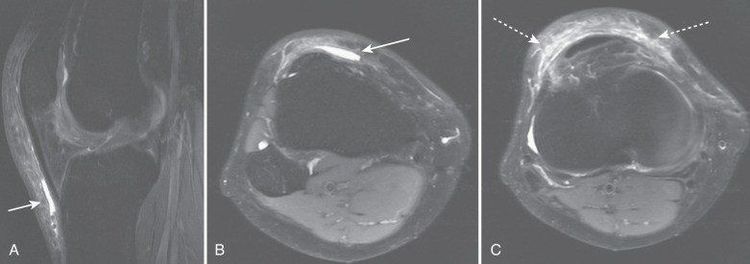 
Chẩn đoán phân biệt với viêm bao hoạt dịch dưới xương bánh chè nông trên MRI
