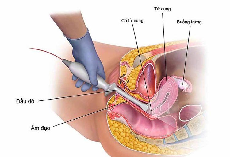 
Siêu âm đầu dò giúp chẩn đoán nhiều bệnh lý phụ khoa
