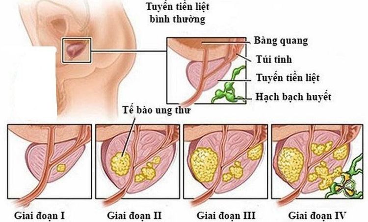 
Hình minh họa các giai đoạn của ung thư tiền liệt tuyến
