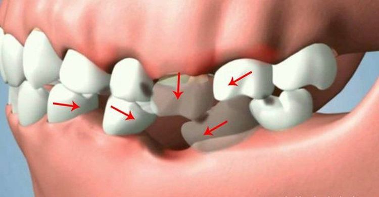 
Trường hợp mất răng hàm sẽ được chỉ định làm cầu răng sứ
