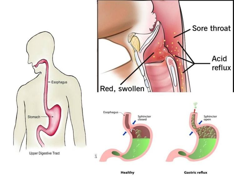 
Trào ngược các thành phần từ dạ dày có thể gây nên bệnh lý viêm thanh quản trào ngược
