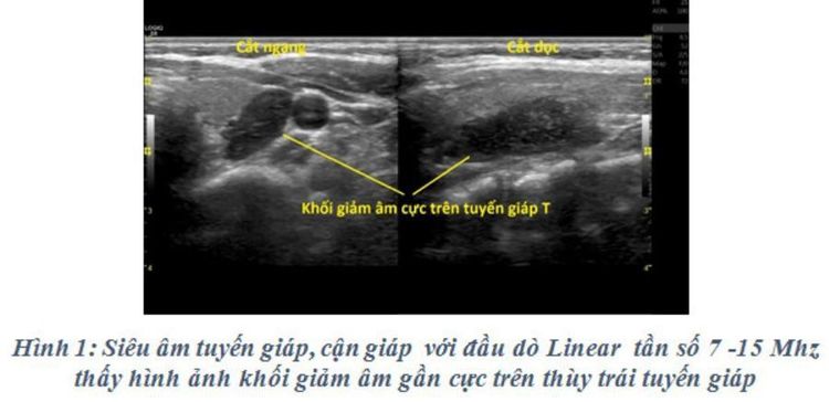 
Hình ảnh siêu âm u tuyến cận giáp giúp bác sĩ đưa ra chẩn đoán chính xác
