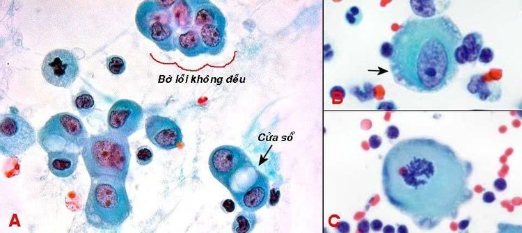 
Hình 1: Tế bào trung mạc nằm riêng rẽ hoặc kết đám nhỏ bờ lồi không đều, tế bào có bờ rõ, giữa 2 tế bào có thể thấy cửa sổ (A); tế bào bờ không rõ do có viên đăng-ten (mũi tên, B), tế bào trung mạc đang phân bào (C).
