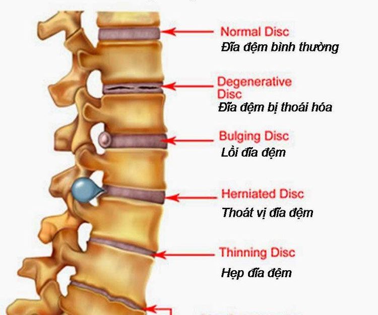 
Quá trình phồng lồi đĩa đệm có thể diễn ra trong một khoảng thời gian dài, càng kéo dài sẽ càng nghiêm trọng.
