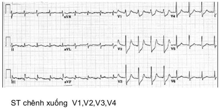 
Hội chứng nhồi máu cơ tim cấp không tăng sóng ST trên kết quả điện tâm đồ
