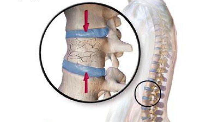 Xẹp đốt sống L1 kèm chèn ép dây thần kinh tọa điều trị như thế nào?