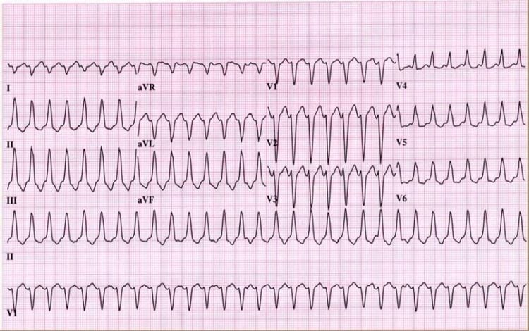 
Kết quả ECG nhịp nhanh thất đơn dạng bền bỉ
