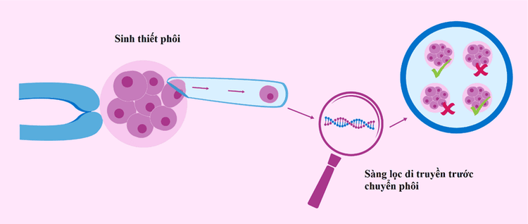 
Sàng lọc trước khi chuyển phôi giúp phát hiện những bất thường khiến IVF thất bại
