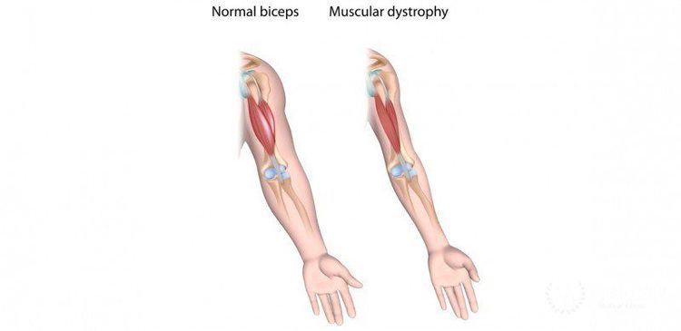 
Bệnh lý loạn dưỡng cơ Duchenne gây ra hiện tượng nhão cơ
