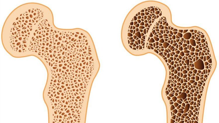 
Ngay cả những nữ vận động viên có kinh nguyệt đều đặn vẫn có thể có mức mật độ xương (BMD) thấp
