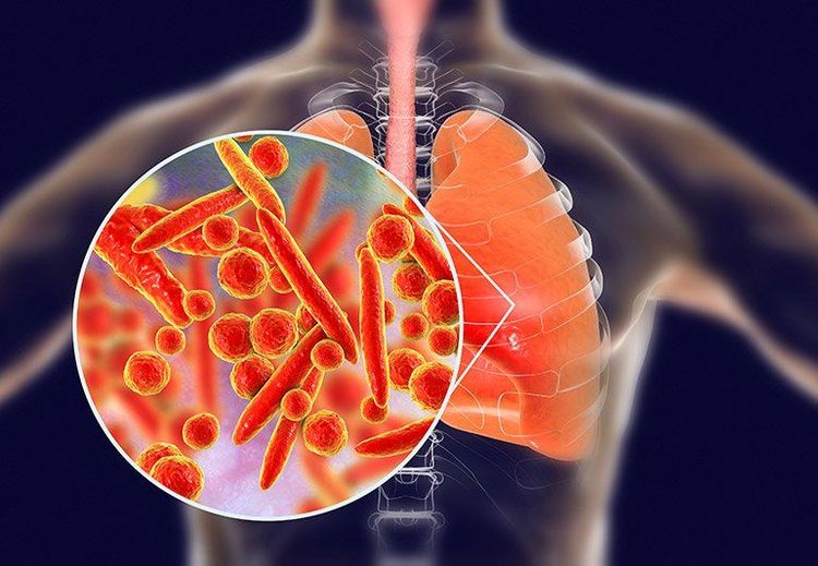 
Vi khuẩn Mycoplasma gây viêm phổi ở người nhiễm
