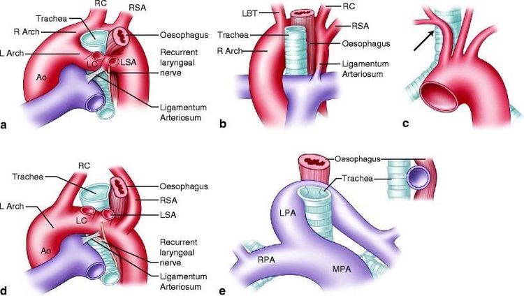 
Nguyên nhân thở khò khè do các bất thường động mạch từ hoàn toàn đến không hoàn toàn (a–Động mạch chủ đôi e;- Sling động mạch phổi)
