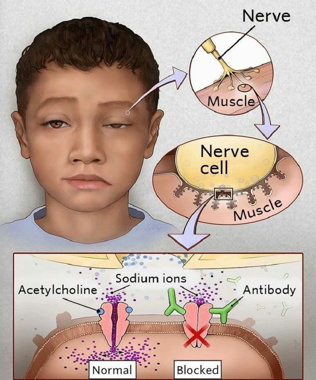 
Xét nghiệm acetylcholine receptor Ab (AChR) có vai trò quan trọng trong chẩn đoán bệnh nhược cơ
