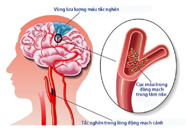 
Nhũn não là hậu quả của tình trạng tắc nghẽn mạch máu nuôi vùng não, dẫn tới nhồi máu não.
