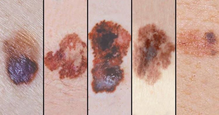 
Thuốc Pembrolizumab được chỉ định điều trị U hắc bào ác tính (melanoma)
